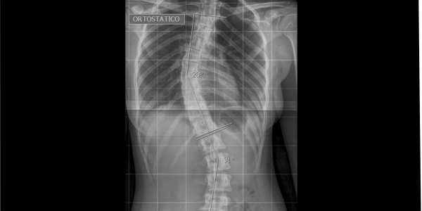 B - RX PANORÂMICO DE COLUNA VERTEBRAL